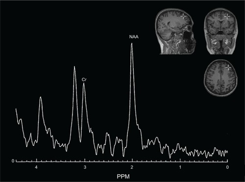 Figure 1 Left dorsolateral prefrontal cortex.