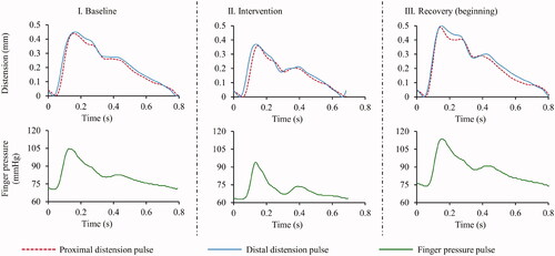 Figure 2. Sample proximal and distal distension pair and finger pressure pulse cycles recorded during different phases of the experiment on a subject, baseline (left column), mid of intervention (center column) and the beginning of recovery post intervention (right column).