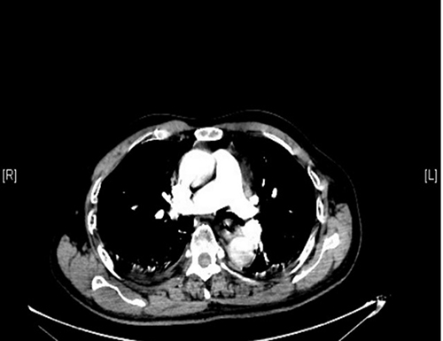 Figure 3 Contrast-enhanced CT of the chest showed no obvious filling defect in the pulmonary artery.