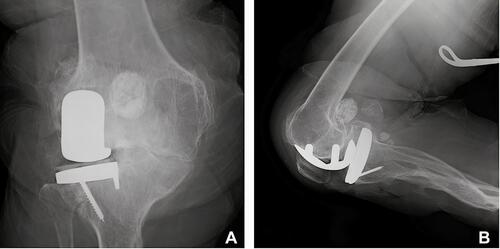 Figure 4 Perioperative radiographs of the trial implant taken from the anteroposterior direction during (A) extension and from the lateral direction during (B) flexion; note the visible gap between the femoral condyle and implant in the latter image.