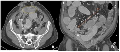 Figure 2 PET NaF showing focal abnormal uptake at (A) the left parietal-temporal skull and (B) the left 6th rib both suspicious for metastatic disease.