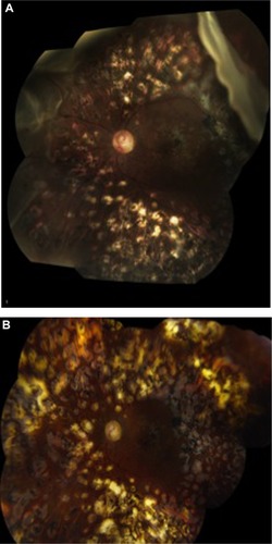 Figure 1 Fundus photo of a 52-year-old man with a history of proliferative diabetic retinopathy status-postpan-retinal photocoagulation who had initially undergone pars plana vitrectomy for nonclearing vitreous hemorrhage and subsequently developed a superior giant retinal tear macula-sparing retinal detachment (A). He underwent pars plana vitrectomy/endolaser/fluid–air exchange/silicone-oil infusion. His retina remains attached 4 years postremoval of silicone oil with a best-corrected visual acuity of 20/200 (B).