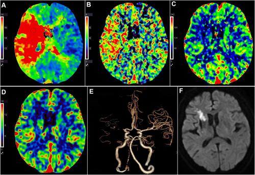 Figure 1 Case illustration of MRI-ASPECTS score. (A) TTP was prolonged in M1, M2, C, L and IC areas in right hemisphere than in corresponding contralateral brain tissue with TTP-ASPECTS score 5. (B) MTT was prolonged in M1, M2, C, L and IC areas in right hemisphere than in contralateral brain tissue with MTT-ASPECTS score 5. (C) The decrease of CBF in M1, C and IC areas in right hemisphere compared with contralateral corresponding areas with CBF-ASPECTS score 7. (D) The decrease of CBV in C and IC areas in right hemisphere compared with contralateral corresponding areas with CBV-ASPECTS score 8. (E) 4D-CTA showed the occlusion of right middle cerebral artery. (F) DWI demonstrated high signal intensity in C and IC areas in right hemisphere after 5 days of mechanical thrombectomy therapy with the MRI-ASPECTS score 8. The patients discharged with the recovery of the muscle strength of the left limb and can walk normally.