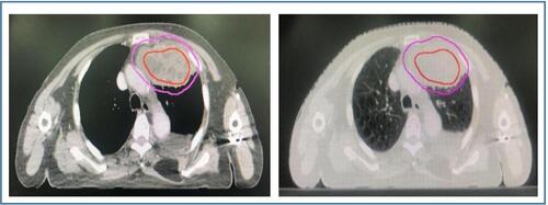 Figure 2 Treatment planning: image of GTV for the SIB technique; the internal area is GTV1 with dose at the level of 65.5 Gy (red), and the peripheral area is GTV2 shown at the level of 50 Gy (pink).