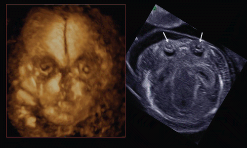 Figure 40.  Congenital cataract at 14 weeks of gestation. Bilateral congenital cataract with microphthalmia is demonstrated as lens opacity (arrows) in 3D (left) and 2D (right) images.