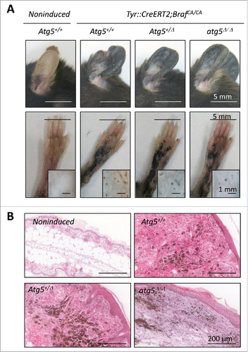 Figure 6. Atg5 is dispensable for nevi formation driven by oncogenic BrafV600E in genetically modified mice. (A) Hyperproliferative pigmented lesions generated in the tamoxifen responsive Tyr::CreERT2;BrafCA/CA mice crossed to Atg5flox/flox animals for assessment of Atg5 gene dosage (Atg5+/−, Atg5+/Δ or atg5Δ/Δ) in the melanocytic compartment. Shown are images of lesions generated in ears, paws or the back skin (the latter in insets) captured 6 mo after tamoxifen induction. Equivalent anatomical areas in tamoxifen-untreated (noninduced) Tyr::CreERT2;BrafCA/CA;Atg5+/− control animals are also included as a reference. (B) Visualization of ATG5 protein levels by immunohistochemical staining (pink) of paraffin-embedded ear sections of animals of the indicated genotypes and treated as in (A). Nuclei were counterstained by hematoxilin. The brown color corresponds to melanin.