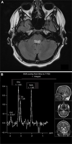 Figure 2 Axial MRI scan (A) and MRS spectrum (B) of a 17-year old male with Leigh syndrome due to a mutation in the mtDNA.