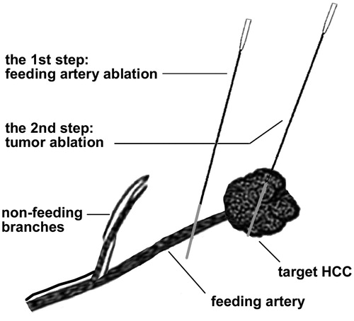 Figure 2. The practical technique of FAA as add on to RFA. FAA was performed by ablating the target feeding artery but sparing the non-feeding branches, and after that RFA was performed to ablate the tumor. FAA: feeding artery ablation.