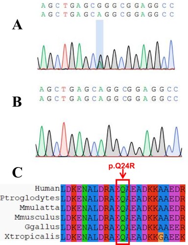 Figure 2. Sanger sequencing results and homology comparison. A. Sanger sequencing result of the proband. B. the result of normal human Sanger sequencing. C. Homology alignment of missense mutation sites