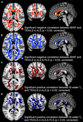 Figure 3. Regional white matter tract correlations, notably including anterior corpus callosum and frontal projections, between higher TMT B-A scores (reflecting dysexecutive function) and reduced MWF in the ALS group (A), in the ALS and PLS patients combined (B); IE-water T2 increases in ALS patients (C) and IE-water T2 increases in the combined group (D). All p-values corrected for multiple comparisons. Images displayed by radiological convention.