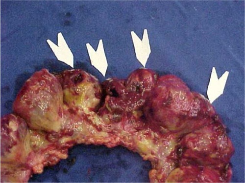 Figure 7 Diffuse ileal and colonic lesions and perforations (arrows).
