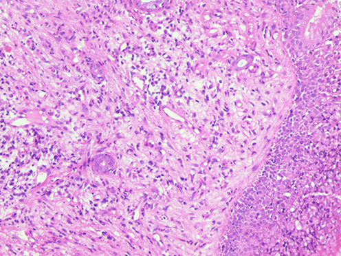 Figure 3 The nasal endoscopic biopsy section indicates inflammatory polyp with chronic suppurative inflammation and inflammatory granulomatous hyperplasia. (Hematoxylin-eosin stain).
