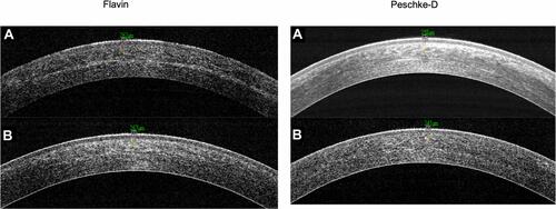Figure 8 ASOCT image showing demarcation line depth at (A) 1-month and (B) 3-months postop for one eye each with Flavin and Peschke-D riboflavin dye.