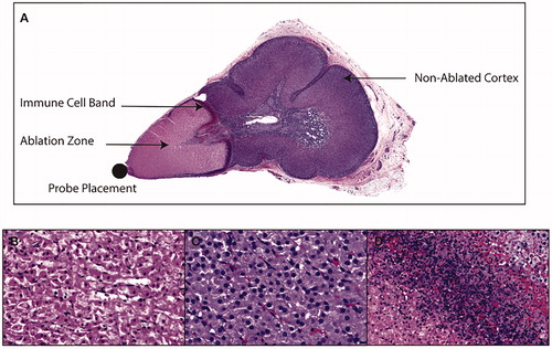 Figure 3. (A) A cross-section of ablated adrenal gland, stained with H&E, demonstrating subtotal ablation of the adrenal gland, with cortical sparing and a delineating transitional zone containing an immune cell infiltrate. (B) Typical features of coagulative necrosis in the adrenal cortex within the so-called ablation zone adjacent to microwave applicator probe placement. (C) Non-targeted adrenal cortex distal to probe placement, which contains zona fasciculata cells of normal morphology, and which are morphologically identical to sham adrenal cortex. The transitional zone between ablated and non-ablated tissue was characterized by an immune infiltrate (D).