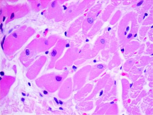Fig. 2 Eosinophilic degeneration, lack of stration, and pycnotic nuclei of cardiomyocytes as well as single intracellular vacuoles (2DOX+GT, H+E, objective mag.×40).