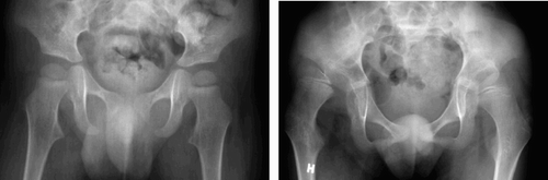 Figure 2. A boy with spastic quadriplegia. A. The hips are normal at 2 years of age. B. The right hip is severely subluxated at 10 years of age (MP increase 8.5% per year in the right hip and 4.2% inthe left).