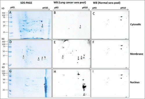 Figure 2. Immunoreactive proteins were detected by autoantibodies in serum samples from lung cancer patients. 2-DE gel electrophoresis of H1299 subcellular fractions (cytosolic, membrane and nucleus) were stained by Coomassie blue (2A, 2D and 2G). 2-DE Western blotting of H1299 subcellular fractions with the pool of sera from LC patients (n = 5 from group 1: line 1–5 in Fig. 1C) (2B, 2E and 2H) and with the pool of sera form normal individuals (n = 5 from group 2: line 6–10 in Fig. 1C) (2C, 2F and 2I).