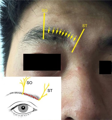 Figure 4 The incision that can be made inside the brow (yellow arrow and red line: intrabrow incision).