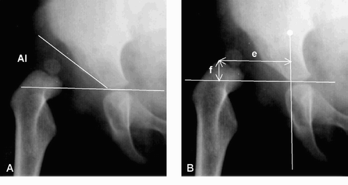 Figure 1. Radiographic measurements. Panels A and B show the primary radiograph of a 15-month-old girl with a dislocated right hip. AI is the acetabular index. The lateral (e) and vertical (f) metaphyseal distances are indicated.