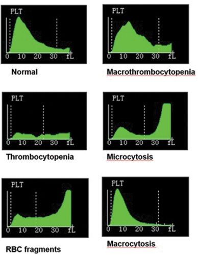 Figure 3. Platelet impedance distributions observed in various pathological conditions including a normal sample and patients with macrothrombocytopenia, thrombocytopenia, microcytosis, red cell fragments and macrocytosis to illustrate how an upper floating gate influences the platelet distributions All samples were tested on a Mindray BC6800 analyzer.