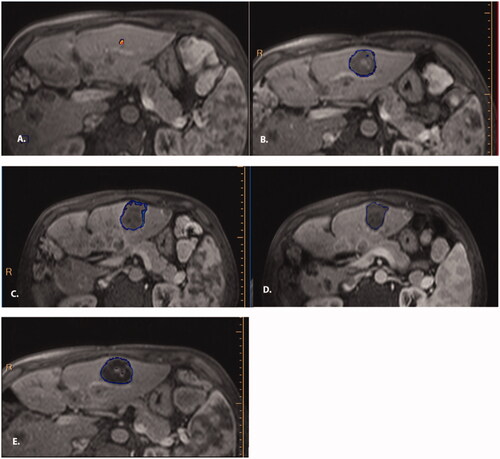 Figure 2. Representative qEASL image. Contrast-enhanced MRIs obtained at baseline (A) and 24 hours (B), 1 week (C), 1 month (D), and 2 months (E) posttreatment in a patient with diffuse colorectal liver metastases who had undergone multiple types of therapy including surgical resection and several lines of systemic chemotherapy. A small lesion in segment 2 measuring 1 cm in diameter was treated with histotripsy. The three-dimensional measurement known as qEASL (quantifiable European Association for the Study of Liver) was performed using a semiautomatic tumor segmentation software (Philips Healthcare). The qEASL algorithm quantified the tumor diameter, absolute tumor volume, and enhancing tumor volume as absolute numbers as well as the percentage of the enhancing tumor volume. In a previous radiology-histopathology study, excellent correlation between the appearance on MR imaging and the findings at pathology both in terms of tumor viability (enhancing on MRI) and necrosis (lack of enhancement on MRI) confirmed the usefulness of qEASL mapping to assess tumor response [Citation22,Citation23].