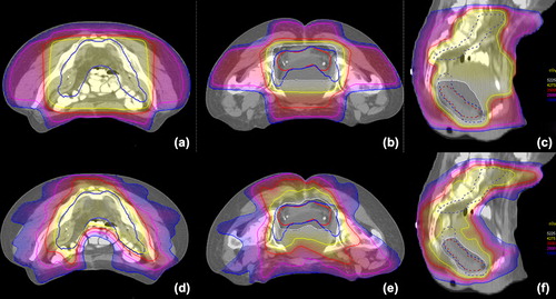 Figure 1. Axial, and sagittal view of 3D CRT CB (a, b, c) and SIB-VMAT (d, e, f) representative isodose distributions on PTV2 (blue contour) and PTV1 (red contour). Yellow (V42.75) and white (V52.25) isodoses correspond to 95% of PTVs prescription dose. Red (V35), pink (V25) and blue (V15) isodoses correspond to low-intermediate dose levels. Sparing of the contrast-enhanced small bowel and bladder by the SIB-VMAT plans is clearly visible.