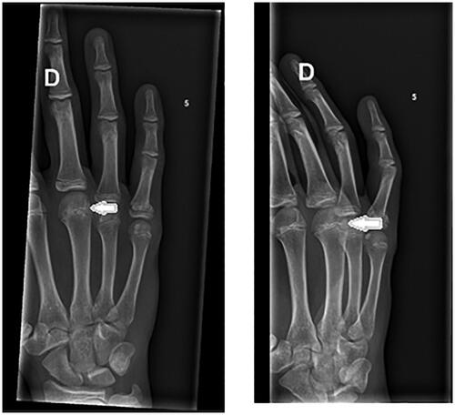 Figure 1. Radiograph July 2022, osteolysis of the third metacarpal head with sclerosis.