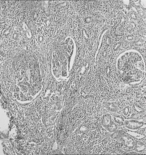 Figure 1. Dense mononuclear cell infiltration of interstitium with tubular atrophy and crescentic glomeruli, HE × 100.