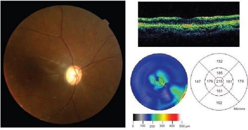 Figure 3 Optical coherence tomographic image and fundus photograph one month after the accident. Left: Fundus photograph of right eye showing optic atrophy. right: Axial slice (upper) and retinal thickness analysis (lower) of optical coherence tomographic image.
