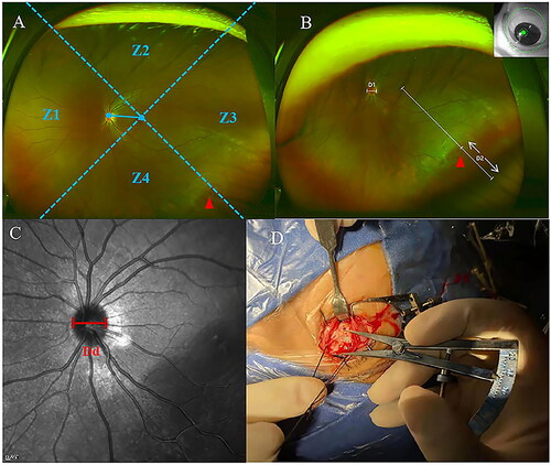 Figure 1. (A) Z1, the nasal side; Z2, the superior side; Z3, the temporal side; Z4, the inferior side. (B) D1, optic disc transverse diameter; D2, the distance between the centre of the retinal hole and the edge of the image in the extension line of the macular fovea and retinal hole. The Optos images were taken when the patients did their best to stare in the direction of the retinal holes. (C) Dd, the optic disc transverse diameter measured by optical coherence tomography. (D) The chord length is measured between the limbus and retinal hole mark during the operation. Red triangles: retinal holes.