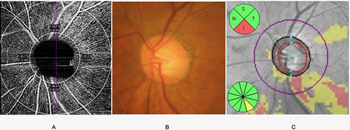 Figure 1 The optic nerve and peri-papillary area; (A) OCTA and segmentation into superior inferior nasal and temporal quadrants, (B) disc photography, (C) peri-papillary OCT retinal nerve fiber layer thickness.