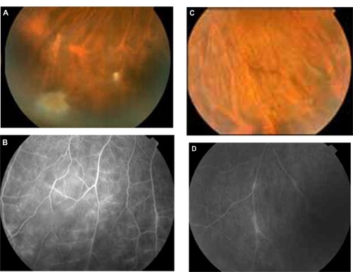 Figure 4 Patient with bilateral intermediate uveitis and peripheral vasculitis (increased IgG titers against B. quintana; patient 8 in Tables 2 and 3). (A) and (B) right eye with snowballs masking the vessels with mild vasculitis in fluorescein angiography (FA), (C) and (D) the vasculitis is more prominent in left eye; in FA segmental periphlebitis is present.