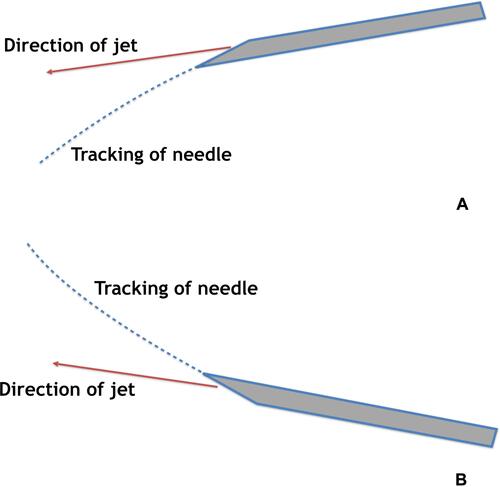 Figure 8 Effect of bevel position on the direction of tracking of the needle. (A) Effects of bevel position up and (B) effects of bevel position down.