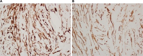 Figure 3 Immunohistochemistry demonstrating positive vimentin (A) and actin (B).