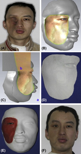 Figure 16. (A) Patient with facial malformation. (B) A margin 2 mm wide was measured and cut. (C) A layer of the virtual preliminary prostheses 0.5 mm thick was subtracted (a) and the subtracted layer of 0.5 mm magnified (b). (D) Rapid prototype wax prosthesis. (E) Finished wax prosthesis with surface texture, follicular orifices, and adaptable margin. (F) Patient with final silicone prosthesis. Adapted from reference (Citation239) with permission of British Journal of Oral and Maxillofacial Surgery, Elsevier, Copyright 2010.