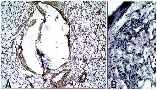 Figure 3. Optical Microscopy with orcein staining. Lung damages related to the needle positioning alone, without any thermo-ablation. A: Biopsy path without haemorrhagic modifications, peripheral parenchyma is preserved (mag ×50). B: Hematoxylin staining showing haemorrhagic modifications, with red blood cells in the alveoli (mag ×200).