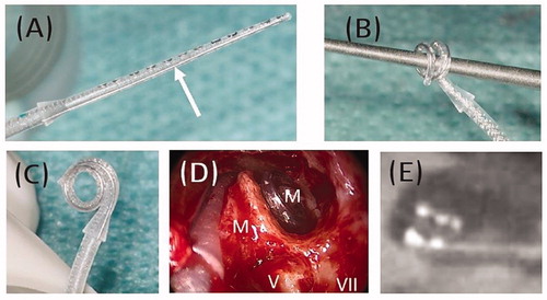 Figure 33. Special electrode with a malleable memory shaped element (A). The electrode array is shaped by rolling the electrode array over a surgical tool (B, C). Shaped electrode takes the optimal position inside the dissected cochlea (D). Postoperative image showing the shaped electrode covering two turns of the cochlea (E) [Citation28]. Image courtesy of Prof. Stefan Plontke, Halle, Germany.
