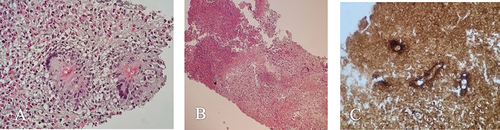 Figure 5 Histopathological study shows various stages of evolution as follows: (A) High-power microscopic image of granulomatous inflammation with marked infiltration of eosinophils, multinucleated giant cells, and Splendore–Hoeppli phenomenon around fungal bodies/hyphae (hematoxylin and eosin staining). (B) Low-power microscopic image of Basidiobolomycosis induced necroinflammation (hematoxylin and eosin staining). (C) High-power microscopic image of GMS (Gomori methenamine silver)-positive Basidiobolomycosis with thin wall, and broad, hyposeptated fungal hyphae; cross- and longitudinally sectioned hyphae.