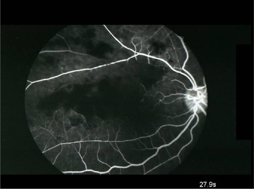 Figure 2 Fluorescein angiography of the right eye showed significantly delayed filling of the branches of the superior retinal artery in the ischemic area (27.9 sec).