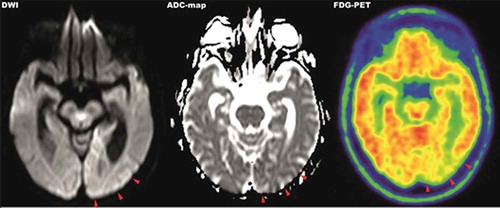 Figure 1. MRI-DWI (left), ADC-map (middle) and 18F-FDG-PET (right) imaging of parietooccipital cortex. MRI imaging showed hyperintense signals in the left occipitoparietal cortex in diffusion-weighted imaging with correlating hypointense signals in the ADC-map. The same area presents hypometabolic in 18F-FDG-PET imaging
