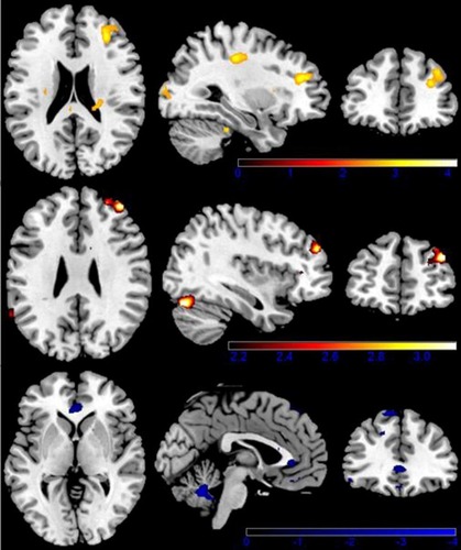 Figure 3 Brain activation when viewing highly caloric food stimuli. Color-coded areas represent activation in restrained eaters (red) and unrestrained eaters (blue). Upper limit z score (represented by color-coded bars) was used to portray activated areas.