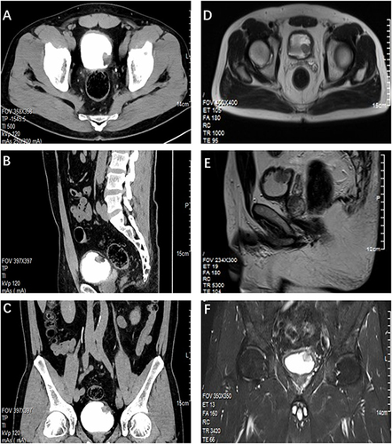 Figure 2 Radiological Imaging of the Patient. (A) Axial CTU view. (B) Sagittal CTU projection. (C) Coronal CTU image. CT urography revealed a nodular soft tissue mass measuring approximately 2.1 cm × 2.0 cm × 2.1 cm on the bladder’s left posterior wall, with surface calcification and mild to moderate enhancement following contrast agent administration. (D) Axial MR image. (E) Sagittal MR image. (F) Coronal MR image. MRI scans display heterogeneous signal intensities within the bladder lesion, with isointense T1 and slightly hyperintense T2 signals.