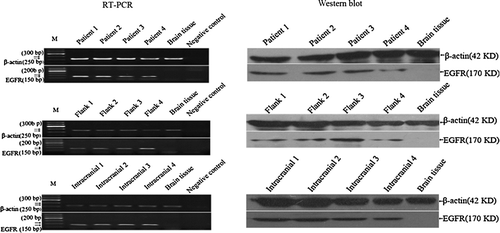 Figure 7  EGFR transcription and expression in xenografts and its original tumors. Compared with human tumors, the overexpressed EGFR gene is retained in the GBM xenografts of 4 different lines by RT-PCR and western blot analysis. No template for RT-PCR is as negative control. Brain tissues from human specimens of surgical decompression without EGFR expression are as normal control.