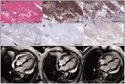 Figure 1. Typical histopathologic findings of ECD and detection of BRAFV600E mutation (case 1). Tissue sample of the perinephric mass is characterized by an extensive xanthogranulomatous fibro-inflammatory reaction. Numerous foamy macrophages are present, accompanied by fibrosis and lymphoplasmacytic cell infiltration (A). Immunohistologically, macrophages were strongly positive for CD68 (B) and Factor XIIIa (C) and negative for CD1a (D) and S100 (E). The BRAFV600E mutation was detected with a BRAFV600E mutation-specific antibody (Clone VE1, Spring Bioscience, Pleasanton, CA) (F). The mutation was confirmed by PCR amplification at amino acid position 600 with an in house protocol and subsequent sequencing using the Pyromark Q24 (QIAGEN, Hilden, Germany, detection limit 10%). Response to treatment assessed by repeated cardiac MRI scanning in case 1. Cardiac MRI scan at presentation (G) and after 6 months (H) and 12 months (I) of SRL treatment, respectively, showed clear regression of pericardial effusion.