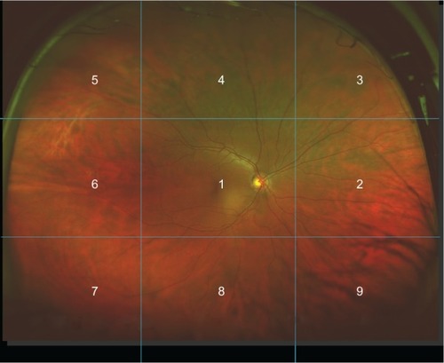 Figure 1 Ultrawide field scanning laser ophthalmoscope (Optomap®) image.