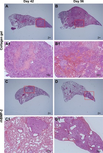 Figure 3 Histopathological appearance of lung metastasis nodules.