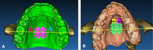 Figure 18 Variation of distance from additional miniscrews to bizygomatic line (BZL), depending on miniscrews location. Distance (red arrows) is much shorter for additional miniscrews placed laterally, between second premolar and first molar (A), than for miniscrews placed anteriorly to MSE body (distance represented by blue arrows) as shown in (B).