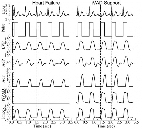 Figure 7. Pressure and flow waveforms under two conditions (baseline represent heart failure, and assisted mode represent iVAD support).