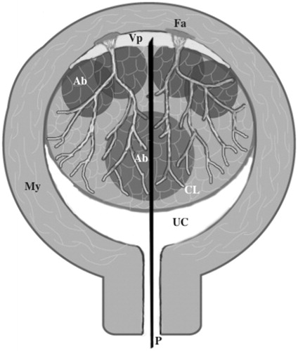 Figure 1. Transcervical injection of a dilute vasopressin solution into the space between the myometrium and surface of the leiomyoma through the leiomyoma using a PTC needle. My: myometrium; P: PTC needle; UC: uterine cavity; CL: cellular leiomyoma; Fa: feeding artery; Vp: vasopressin solution in the space between the myometrium and leiomyoma; Ab: ablation spot.