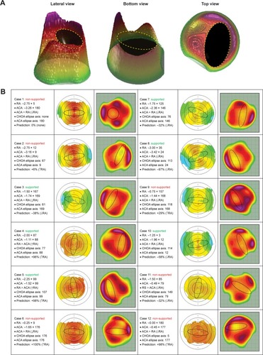 Figure 2 (A) Objective algorithm-based identification of a 3D ellipsoid in a representative Contoura CHOA ablation profile visualized at different angles. The CHOAs’ ellipse axis was calculated using the top view. (B) Case series of 12 eyes used to test Motwani’s claim. Left column, eye parameters; middle column, topographical corneal astigmatism where the ovalization is indicated by a black ellipse; right column, CHOAs’ profile where the ovalization is indicated by a black ellipse as in Motwani’s work.Citation2 Vectorial analyses were used to predict the effect of the interacting ellipses on RA as a positive or negative percentage change, setting both ellipses at equal magnitude. “Supported” and “Non-Supported” identify cases where Motwani’s claim is validated or not, respectively.